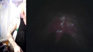 Vore Endoscopy