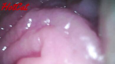 Endoscopic vaginal observation