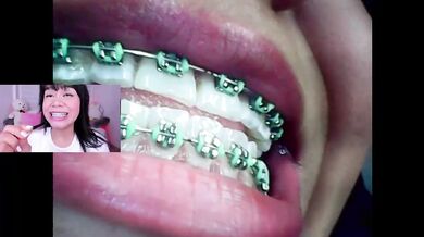 Lila Jordan Mini Cam Vore Endoscope Throat Fucked Brace Clamped Inside OnlyFans